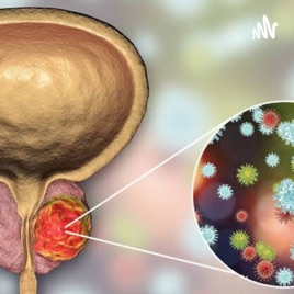 CANCER DE PROSTATA