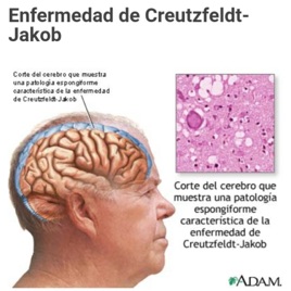 Enfermedad De Creutzfeldt—Jakob