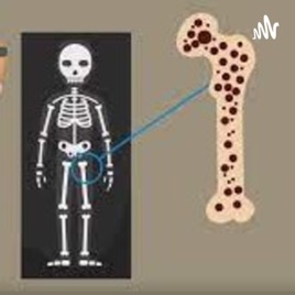 Osteoporosis