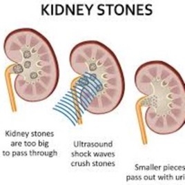 Podcast About Kidney