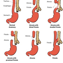 Treatment For esophageal atresia In Babies