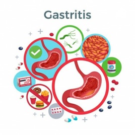 Tudo Sobre a Gastrite.