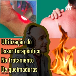 Utilizaçao Do Laser terapêutico Tratamento De Queimaduras