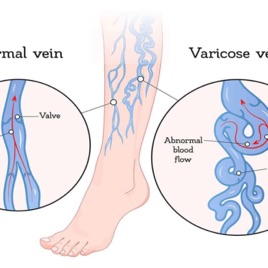 Vein Problems